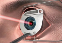 Преимущества лазерной коррекции зрения