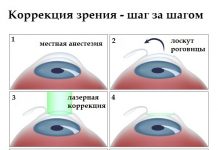 Преимущества лазерной коррекции зрения во Владимире
