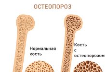Бонвива – лучшее лекарство от остеопороза